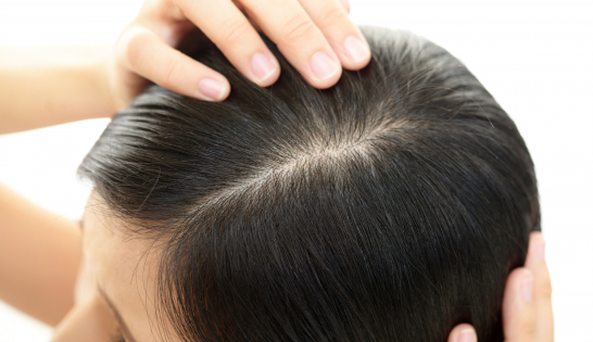 イメージ:薄毛発毛治療は、薄毛や脱毛の進行を抑え、毛髪を再生・増加させるための治療です