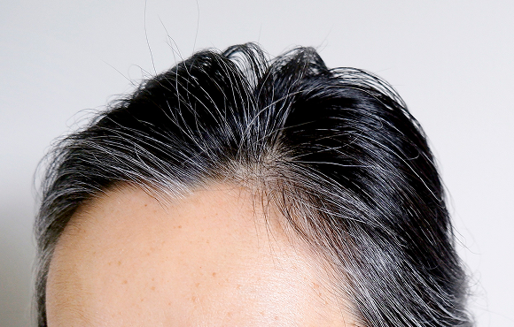 イメージ：男性の薄毛